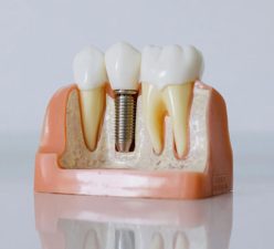 Permanent tooth replacement options that look, feel, and function like natural teeth.